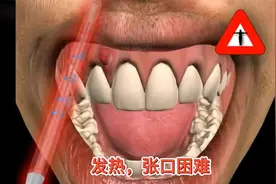长沙牙齿矫正 | 牙龈上长了脓包一定要及时就医视频封面