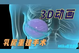 【3D医学动画】三种不同方式的乳房重建手术全过程