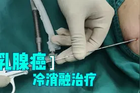 乳腺癌患者也能采用冷消融治疗视频封面