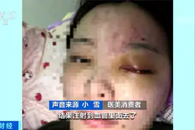 1000元一针？女子注射六针玻尿酸致残  打到血管里造成动脉堵塞视频封面