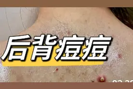 低成本除螨祛痘法！轻松一招！仅仅10天！后背黑头粉刺彻底断根！