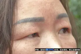打完玻尿酸第二天皮肤红肿，“艺美”说“流程没问题”视频封面