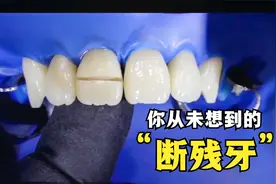 大门牙被磕断了，说话漏风怎么办，牙医能用胶水粘接上去吗