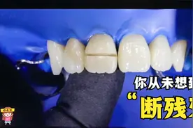 大门牙被磕断了，说话漏风怎么办，牙医能用胶水粘接上去吗视频封面