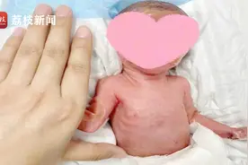 出生时仅0.9公斤！南通市一院成功救治“巴掌婴儿”视频封面