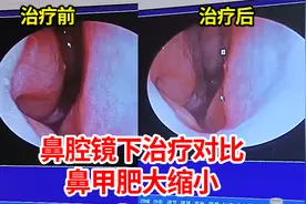 直观对比，鼻腔镜下鼻炎治疗三次，鼻甲肥大缩小，鼻塞鼻涕少多了视频封面