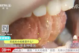 舌底的小疙瘩要注意，质地比较硬就要注意啦，有可能是囊肿视频封面