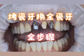 科普烤瓷牙拆除步骤：不想做金属烤瓷牙原因就是核磁共振需要拆除视频封面