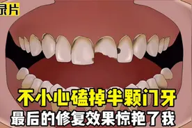美女不小心磕掉半颗门牙，说话一直漏风，最后的修复效果惊艳了我视频封面