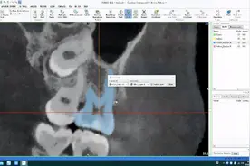 种植体-口腔有限元分析案例演示（下）视频封面