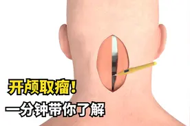 吓人的脑部肿瘤手术，我猜你一定听说过，3D动画一分钟带你了解视频封面