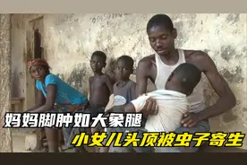 被疾病困扰的非洲家庭，妈妈脚肿如大象腿，小女儿头顶被虫子寄生视频封面