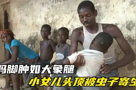 被疾病困扰的非洲家庭，妈妈脚肿如大象腿，小女儿头顶被虫子寄生视频封面
