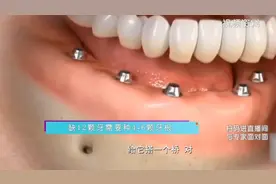 即刻种植牙了解一下！当天种植，当天就能用！视频封面