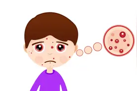 身上长了有疼痛感的疱，多半是带状疱疹，不及时治疗会留后遗症视频封面