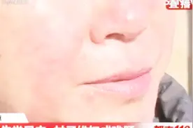 面部红肿，还有大面积的痘痘，女子脸上成这样竟是因为做了这个！视频封面