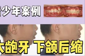 正畸日记 | 11岁男孩 骨性大龅牙 不拔牙导下颌向前1年多隐形矫治视频封面