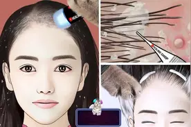 美女长满头皮屑，第一视角体验猫医生清理全过程，视频超解压下饭视频封面