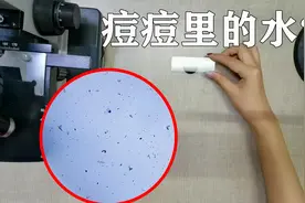 皮肤疙瘩挤出的水，真的有那么清澈吗？显微镜下一看便知视频封面