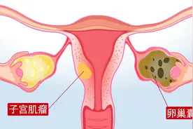 卵巢囊肿超过这个尺寸可能影响怀孕  最好先治好病再备孕！