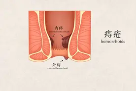 肛门肿物脱出，警惕4大疾病！视频封面