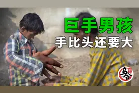 从未见过如此之大的手，竟有43cm长，手比头还大，巨手男孩纪录片