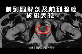 回答网友问题（一）：前列腺解剖及外周带前列腺癌的核磁表现视频封面