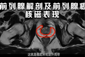 回答网友问题（一）：前列腺解剖及外周带前列腺癌的核磁表现视频封面