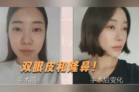 90后广州女孩整容，双眼皮隆鼻手术实拍，术后50天纯素颜对比！视频封面