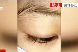 5岁女孩眼睛痒不停，就医后取出20多只活虱子，虫卵还沾在睫毛上