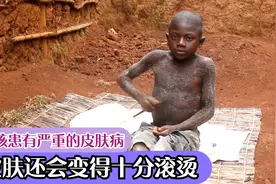 男孩的全身被石头覆盖，有时还会散发出高温，被村民称为石头人视频封面