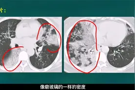 这种肺腺癌有特点：病人吐大量白色泡沫痰视频封面