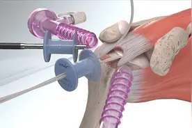 肩袖韧带断裂修复手术 动画视频