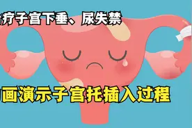 子宫托放入过程，可以缓解子宫下垂，尿失禁，你尝试过吗视频封面