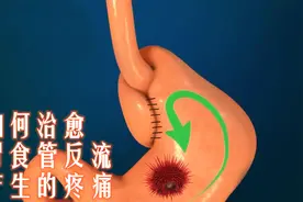如何治愈胃食管反流产生的疼痛视频封面