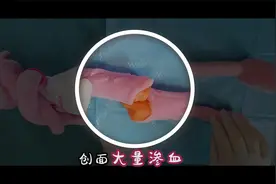 骨折后医生是怎么处理的？骨科医生手术过程大揭秘，一看就懂视频封面