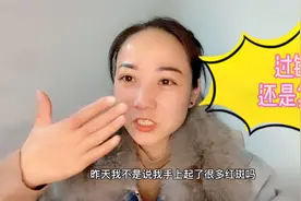 莹莹手上起红斑过一夜又消失，，准备去复查，挂号时间都搞错视频封面