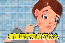 痘痘里的白色东西，究竟是什么呢，看完你绝对不敢挤了视频封面
