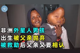 非洲男头部呈葫芦状，出生后就被父亲抛弃，被救助后父亲竟要相认视频封面