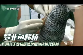 女子为治疗烧伤，医生居然用鱼皮进行移植，没想到最后居然成功了视频封面