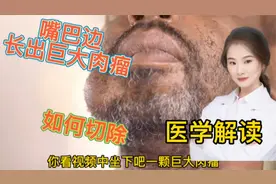 医学解读 人体嘴巴边长出一颗巨大的肉瘤 医生如何进切除视频封面
