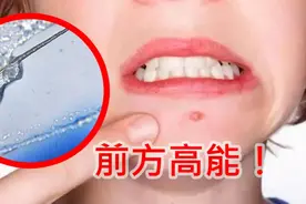 粉刺挤出的白色液体是啥？显微镜下一看，让我省了一顿饭