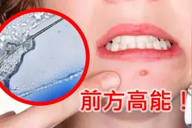 粉刺挤出的白色液体是啥？显微镜下一看，让我省了一顿饭视频封面