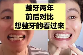 曾医生整牙两年，效果不错，如果你也想整牙，这个视频一定要看！