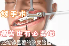 做正颌手术后脸型改变真大，再痛苦也要做，每个人都想有漂亮脸型视频封面