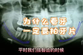 牙片怎么看？拔牙补牙为什么要先拍片子？怎么看牙神经，蛀牙呢？视频封面
