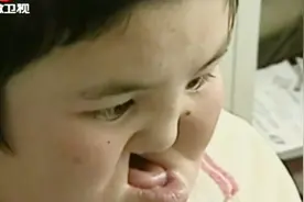 医院来个女病人，揭掉面纱医生吓一跳！这是什么情况？视频封面