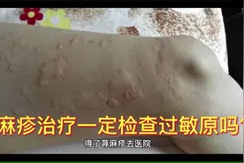 为什么说荨麻疹治疗检查过敏原是个坑，真的需要检查过敏原吗视频封面