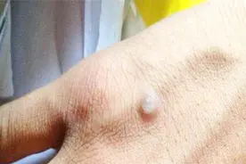 原来这才是去除瘊子的正确方法，3天自动脱落不留痕，省心又省钱视频封面