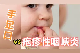 宝宝嘴上有小泡就是手足口？不一定，还有可能是这种病视频封面